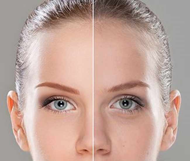 La deuxième voie contre l'acné