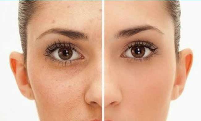 Comment se débarrasser de l'acné