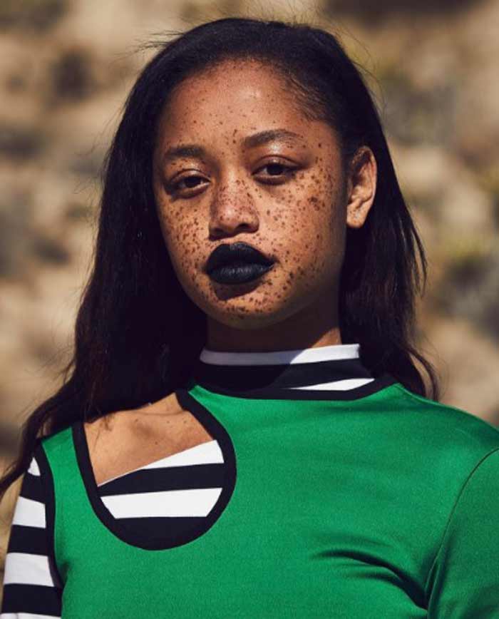 Modèle avec d'énormes taches de rousseur