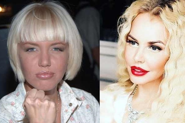 Victimes de chirurgiens plasticiens huit personnalités célèbres