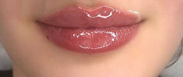 Comment utiliser l'acide hyaluronique à la maison